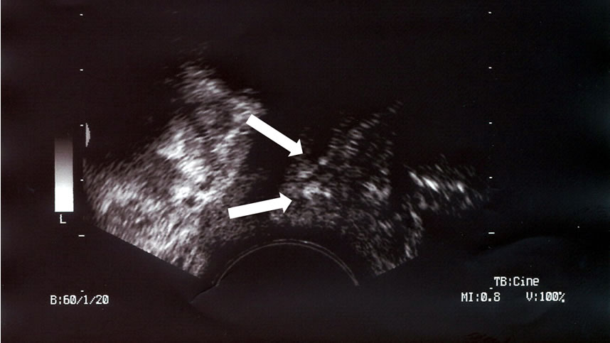 Abb.: Ultraschall vom Scheideneingang („Introitussonographie“) mit 2 implantierten Bändern (s. Markierung).