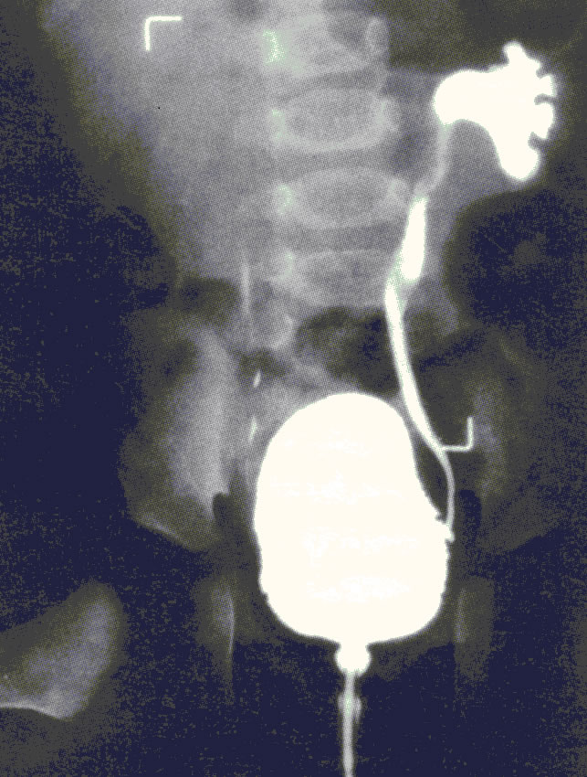 Abb. 1: Refluxkrankheit links: Kontrastmittel in der Blase fließt zur linken Niere zurück; Ursache: Mündungsenge der Harnröhre mit „umgedrehter Zwiebelform“ – unten im Bild