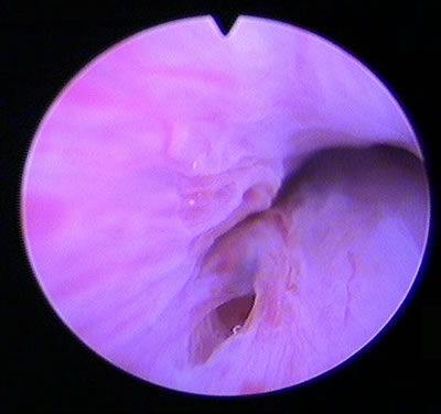 Abb. 1: Eingang in das Divertikel von der Harnröhre aus bei einer Spiegelung gesehen Flüssigkeitsgefülltes Harnröhrendivertikel links und rechts neben der Harnröhre im Ultraschall