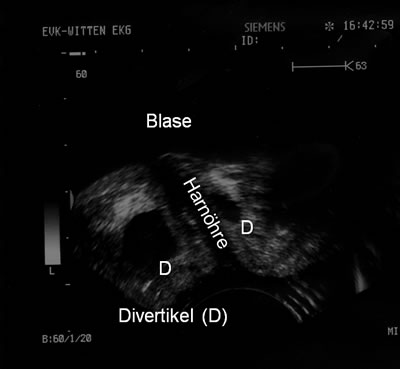 Abb. 2: flüssigkeitsgefülltes Harnröhrendivertikel links und rechts neben der Harnröhre im Ultraschall – schwarz dargestellt