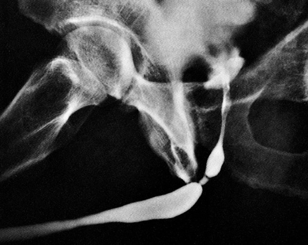 Harnöhrenenge im Röntgenbild
