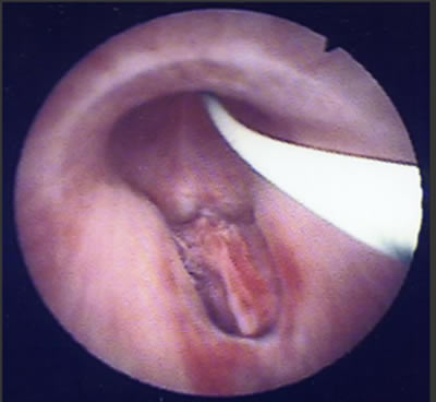endoskopischer Blick auf einen „falschen Weg“ – „via falsa“ unterhalb der Harnröhre (im Bild zunächst mit einem Draht zur sicheren Anlage des Katheters geschient)